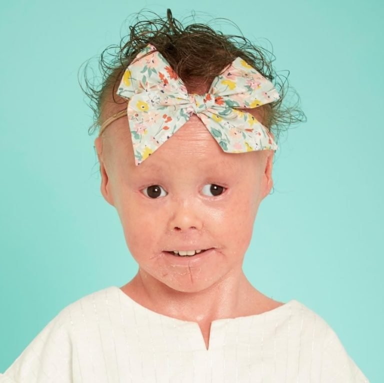 4-Year-Old Model with Rare Skin Condition is Challenging Beauty Standards